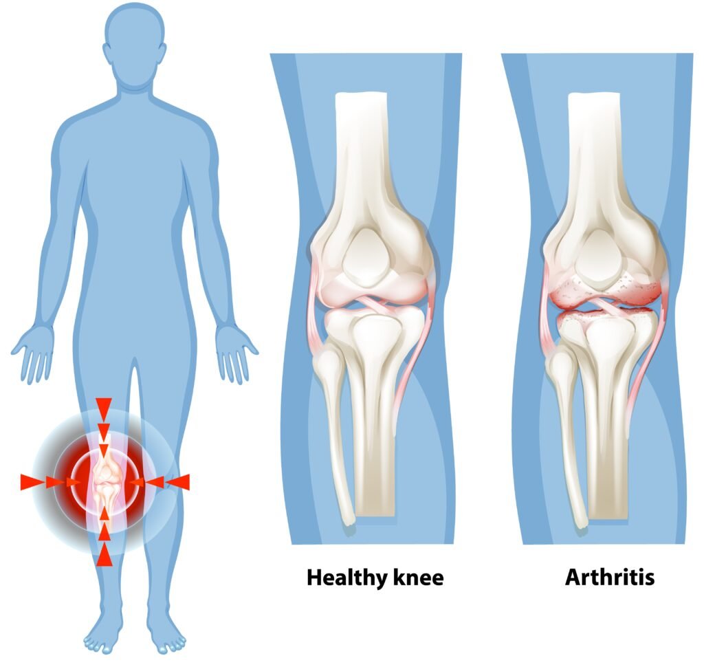 An anatomical illustration of a healthy vs. damaged joint